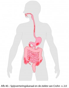 ziekte van Crohn
